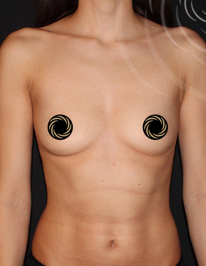 Breast Augmentation Case 01 before