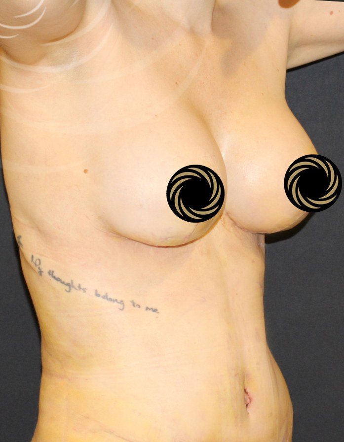 Augmentation + Mastopexy Case after